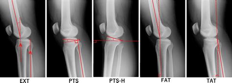 Measurement Of The Five Radiographic Parameters EXT PTS PTS H FAT