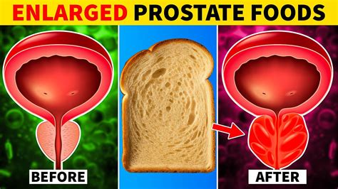 Foods To Avoid With An Enlarged Prostate Youtube