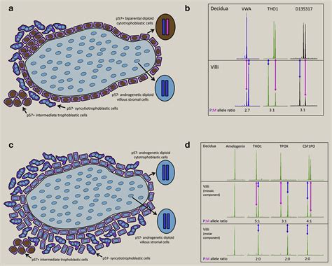 Hydatidiform Moles Differential Diagnosis Diagnostic Reproducibility