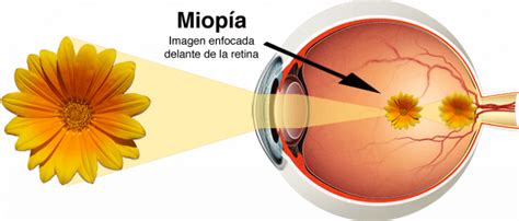 Miopia Cl Nica Oftalmol Gica San Pedro Lucena C Rdoba