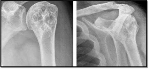 References In Arthroscopic Approach To Simple Bone Cyst Of The Humeral Head—a Step Toward A