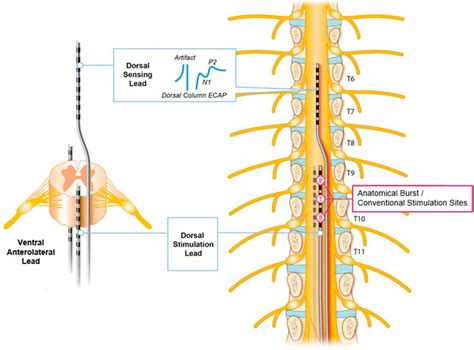 Lead Locations For Burst And Conventional Spinal Cord Stimulation