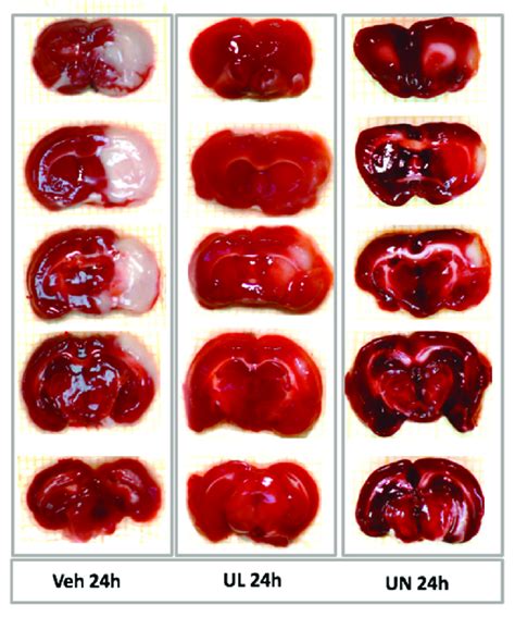 Sections Of The Brain H After The Middle Cerebral Artery Occlusion