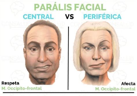 Par Lisis Facial Fonseca Y Ramos Cl Nica Fisioterapia