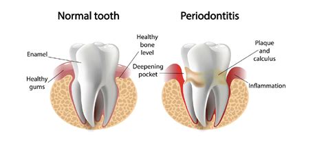 A Comprehensive Periodontal Guide Understanding Gingivitis Vs