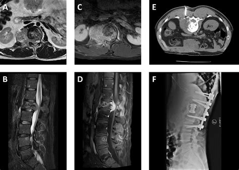 Figure From Anaplastic Meningioma Seeding Of The Abdominal Wall