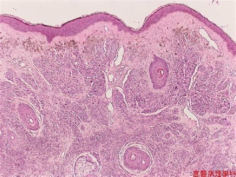 Nevus, Intradermal