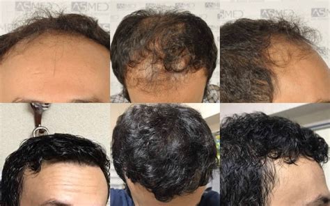 Norwood 6 Hair Transplantation Results Asmed Hair Transplant