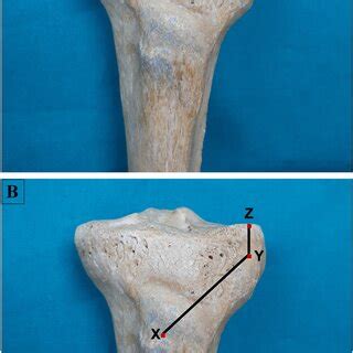 a Superoinferior and mediolateral measurements of Gerdy’s tubercle. TU ...