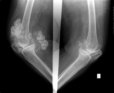 Primary Synovial Chondromatosis Radiology Case Radiopaedia Org