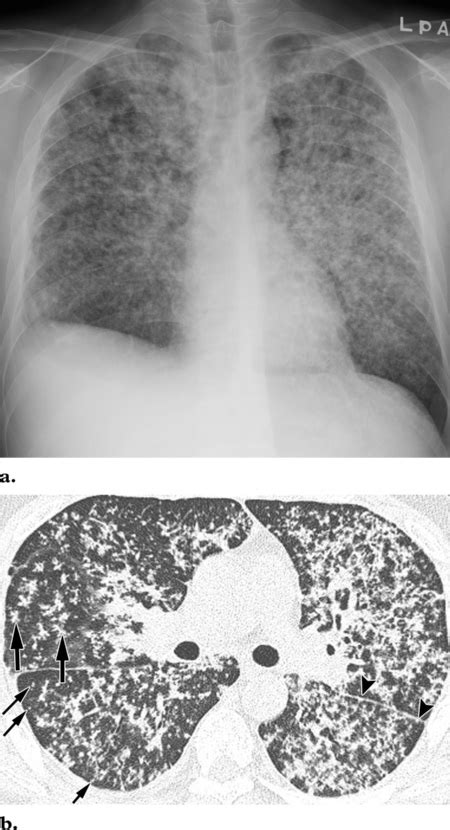 Miliary And Bronchogenic Pulmonary Tuberculosis In A 31 Year Old Man Download Scientific