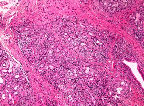 Photomicrograph of sublingual gland biopsy showing diffuse ...