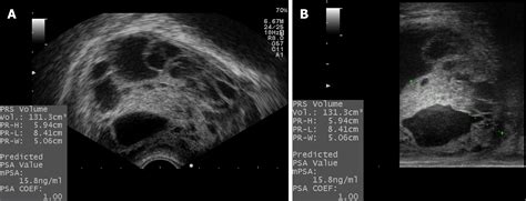 Robotic Surgery In Giant Multilocular Cystadenoma Of The Prostate A Rare Case Report