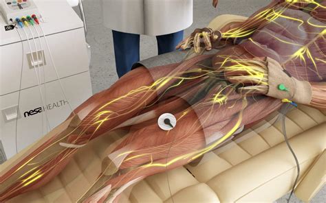 Neuromodulación no invasiva NESA Xsignal Ignis Fisioterapia