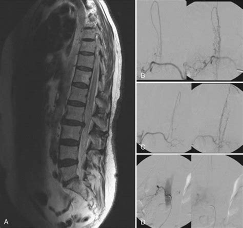 Spinal Vascular Malformations Neupsy Key