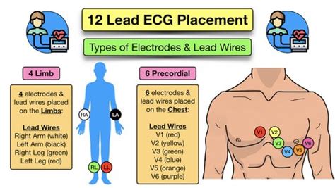 12 Lead Ecg Placement Diagram And Mnemonic For Limb And Precordial