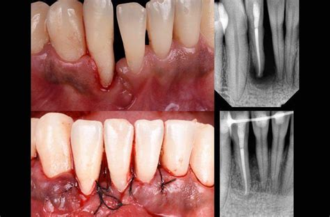 Cirugía Periodontal de última generación Dentisalut