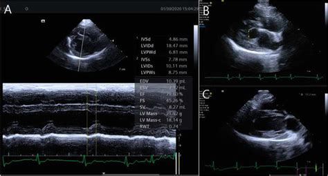 Echocardiographic Features In Canine Myxomatous Mitral Valve Disease