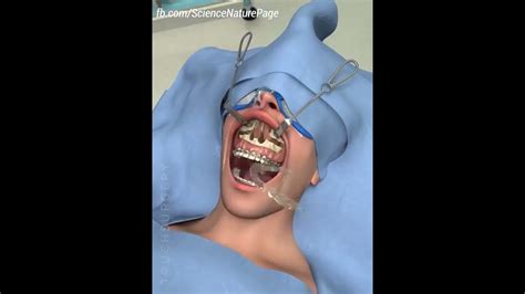 Jaw Correction Surgery Animated Video Medical Surgeon Youtube