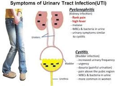 Urinary Tract Infection Treatment Assignment Point