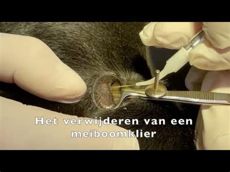 Verwijderen Van Meiboomklier Met Hplt High Power Lasertherapie Youtube