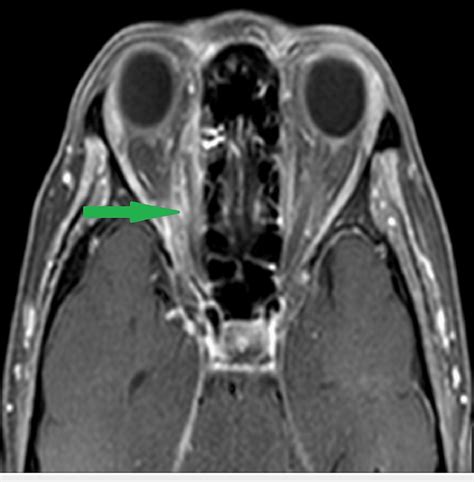 Axial Cut Of Contrast Mri Of The Brain And Orbit Showing Illdefined