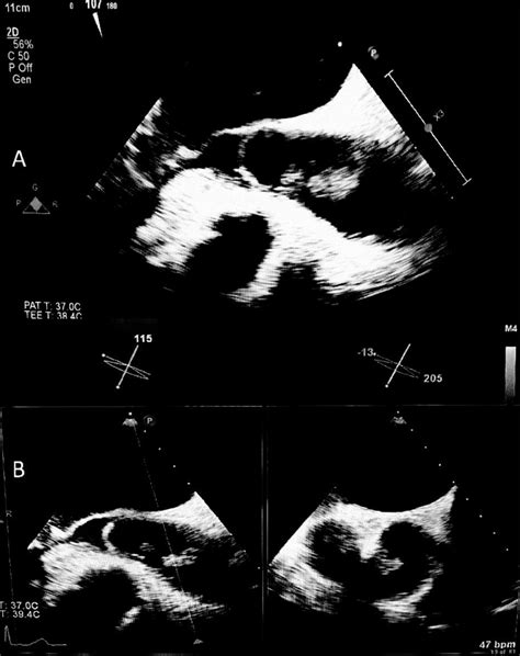 A Transesophageal View Demonstrating A Mobile Pedunculated Aortic Download Scientific Diagram