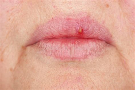 Oral Herpes Simplex Virus Infection Stock Photo Image Of Crusted