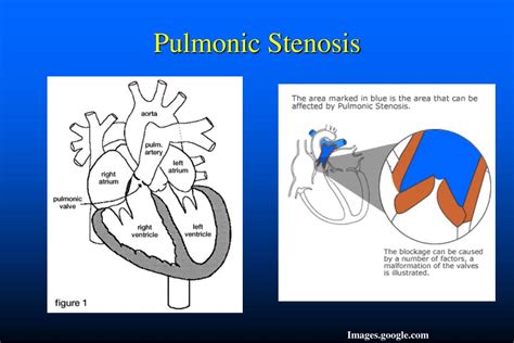 Ppt Congenital Heart Disease Powerpoint Presentation Free Download Id 5186884