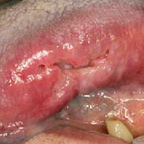 Known Cancer Patient Presenting With A Small Erosive Lesion On The Left