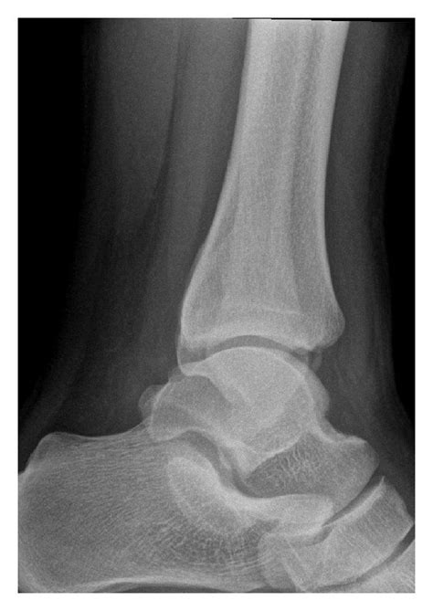 Plan A Anteroposterior And B Lateral Radiographs Of The Left Ankle Download Scientific