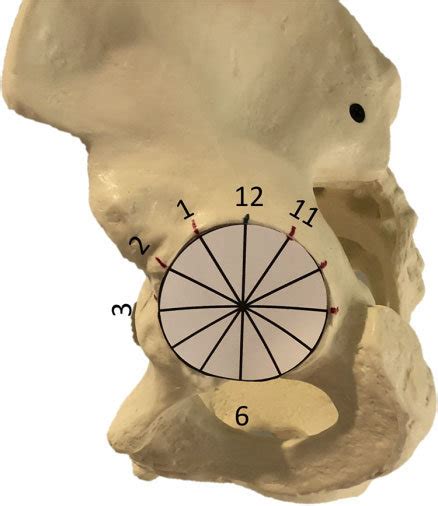 A Representative Sawbone Model Demonstrates The Acetabular Clockface Download Scientific