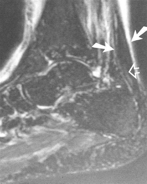 Insertional Achilles Tendonitis Mri