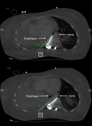 Axial Computed Tomography Scan Of T And T Levels Note The Close