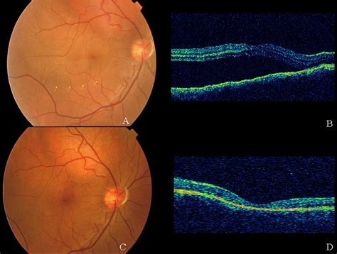 Prospective Clinical Trial Evaluating The Efficacy Of Photodynamic