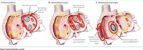 Catheter Ablation Of Atrial Arrhythmias State Of The Art Semantic