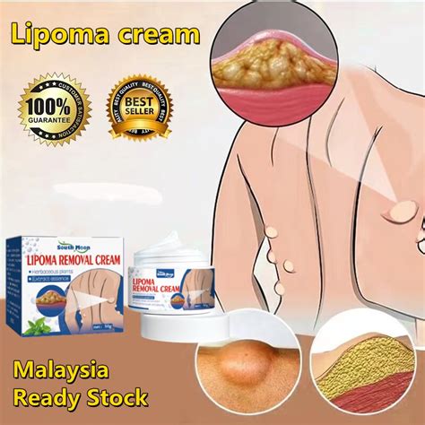 Lipoma Removal Cream Treat Tumor Skin Swelling Ointment Pain Relief