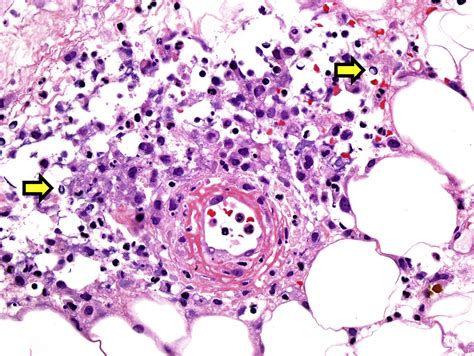 Iodine Toxicity After Iodinated Contrast New Observations In Iododerma