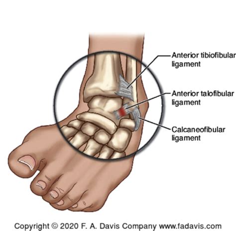 Pta 255 Lateral Ankle Sprainsyndesmotic Ankle Sprainplantar