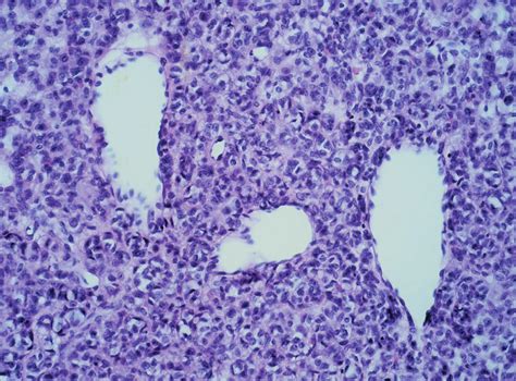 High Power Field Of The Cellular Nodules Show Admixture Of Fibroblasts