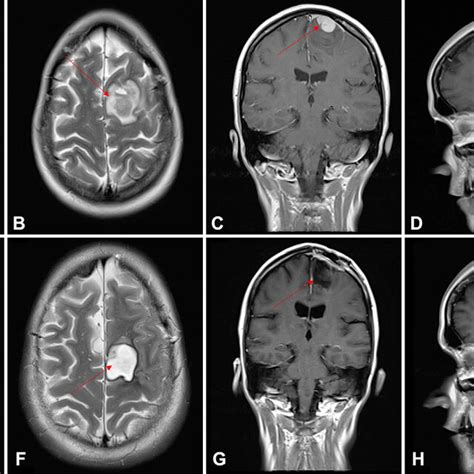 Axial T1 Weighted A And T2 Weighted B Magnetic Resonance Imaging