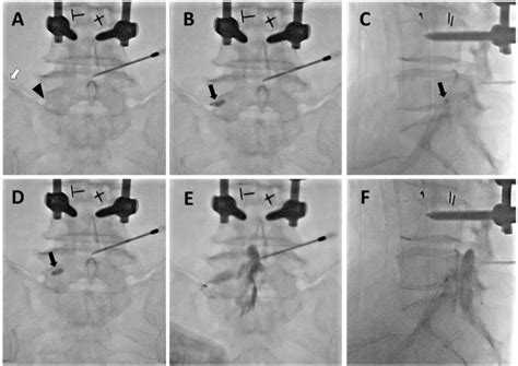 Figure 1 From Transforaminal Epidural Balloon Adhesiolysis Via A Contralateral Interlaminar