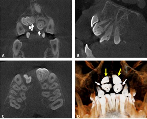 Coronal Sagittal Axial And Cross Sectional Cbct Images That Are