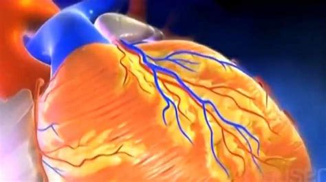 医学3d动画演示：冠状动脉粥样硬化与心肌梗死，医学 健康视频 搜狐视频