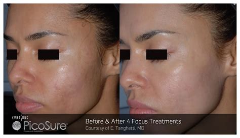 Treatment PicoSure Skin Med Laser