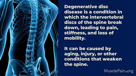 How Can Degenerative Disc Disease Be Prevented Muscle Pain