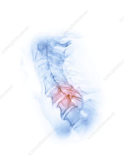 Osteoarthritis Of The Cervical Spine X Ray Stock Image F0281842 Science Photo Library