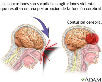 Conmoci N Cerebral Medlineplus Enciclopedia M Dica