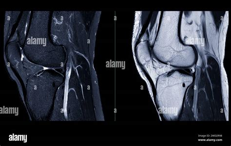 Magnetic Resonance Imaging Or MRI Of Knee Joint This Diagnostic