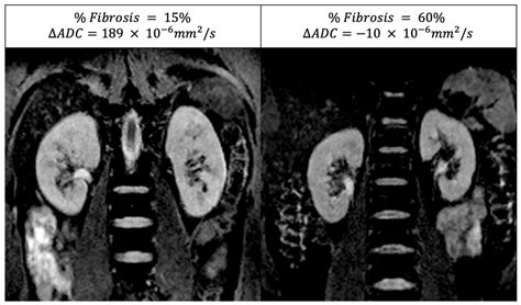 Magnetic Resonance Imaging to Diagnose and Predict the Outcome of
